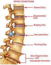 Common Spinal Conditions