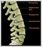 Laser Spine Surgery in India