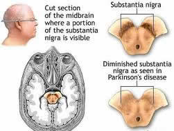 parkinson's diseases surgery India