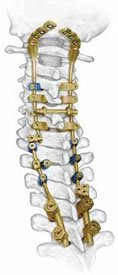 Spinal Fusion Surgery in India
