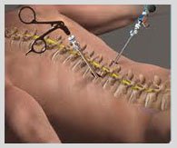 Spine Surgery in India top hospitals